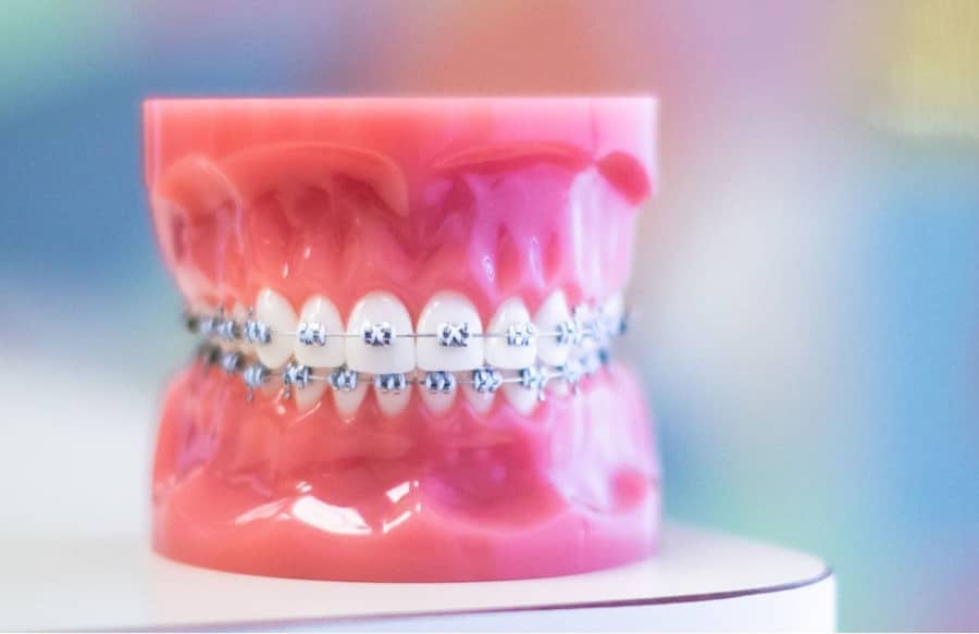 metal braces on plastic model